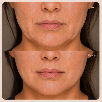 LumenLift™ Jawline Definer